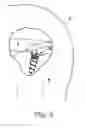 Fig. 06 - Suture anchor device, kit and method