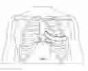 Fig. 01 - Subcutaneous implantable cardioverter-defibrillator placement methods