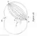 Fig. 04 - Subcutaneous implantable cardioverter-defibrillator placement methods