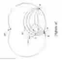 Fig. 05 - Subcutaneous implantable cardioverter-defibrillator placement methods