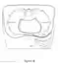 Fig. 10 - Subcutaneous implantable cardioverter-defibrillator placement methods