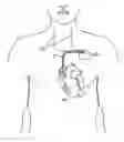 Fig. 01 - Implantable device for treating epilepsy and cardiac rhythm disorders