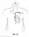 Fig. 02 - Implantable device for treating epilepsy and cardiac rhythm disorders