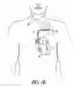 Fig. 03 - Implantable device for treating epilepsy and cardiac rhythm disorders