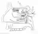 Fig. 01 - Stimulation of the sphenopalatine ganglion for treating depression