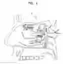 Fig. 02 - Stimulation of the sphenopalatine ganglion for treating depression
