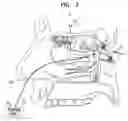 Fig. 03 - Stimulation of the sphenopalatine ganglion for treating depression
