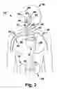 Fig. 04 - Apparatus and method for modulating the baroreflex system