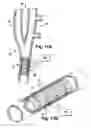 Fig. 10 - Apparatus and method for modulating the baroreflex system