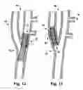 Fig. 11 - Apparatus and method for modulating the baroreflex system