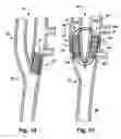 Fig. 12 - Apparatus and method for modulating the baroreflex system