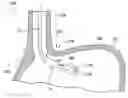 Fig. 01 - Methods and apparatuses for treating an esophageal disorder such as gastroesophageal reflux disease