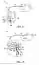 Fig. 03 - Interconnections of implantable lead conductors and electrodes and reinforcement therefor