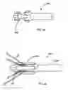 Fig. 10 - Method for aligning a stent graft delivery system