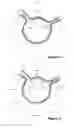 Fig. 03 - Design and assembly of fenestrated stent grafts