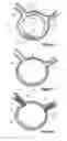 Fig. 04 - Design and assembly of fenestrated stent grafts