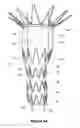 Fig. 06 - Design and assembly of fenestrated stent grafts