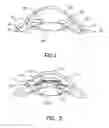 Fig. 02 - Refractive intraocular implant lens and method