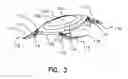 Fig. 03 - Refractive intraocular implant lens and method