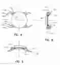 Fig. 04 - Refractive intraocular implant lens and method