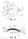 Fig. 09 - Refractive intraocular implant lens and method