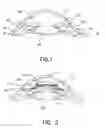 Fig. 02 - Refractive intraocular implant lens and method