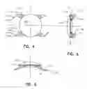 Fig. 04 - Refractive intraocular implant lens and method