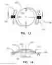 Fig. 08 - Refractive intraocular implant lens and method