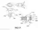 Fig. 10 - Refractive intraocular implant lens and method