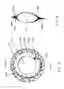 Fig. 07 - Accommodating intraocular lens