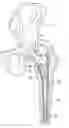 Fig. 01 - Bone graft composition, method and implant
