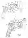 Fig. 02 - Shoulder implant assembly