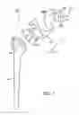 Fig. 07 - Shoulder implant assembly