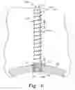 Fig. 07 - Modular hip cup assembly, fastener assembly & fastener
