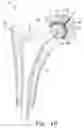 Fig. 12 - Modular hip cup assembly, fastener assembly & fastener