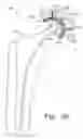 Fig. 25 - Modular hip cup assembly, fastener assembly & fastener