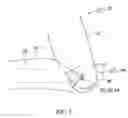 Fig. 04 - Knee cosmesis