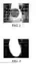 Fig. 02 - Methods of identifying orthodontic adhesives