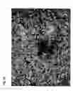Fig. 26 - Method for preparing stem cells from fat tissue