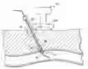 Fig. 01 - Device and method for determining the location of a vascular opening prior to application of HIFU energy to seal the opening
