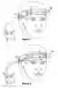 Fig. 02 - METHOD AND APPARATUS FOR RELIEF OF HEADACHE