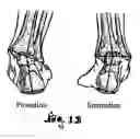 Fig. 05 - Counterforce brace