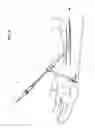 Fig. 07 - Catheter assembly