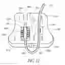 Fig. 10 - Catheter anchoring system