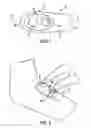Fig. 02 - Valved intradermal delivery device and method of intradermally delivering a substance to a patient