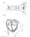 Fig. 06 - Balloon catheter