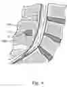 Fig. 05 - Interspinous spacer