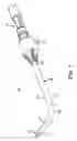 Fig. 02 - Method and apparatus for removing material from an intervertebral disc space, such as in performing a nucleotomy