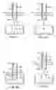 Fig. 04 - Surgical apparatus and method for manipulating one or more osteochondral plugs