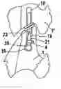 Fig. 01 - Facet joint prosthesis